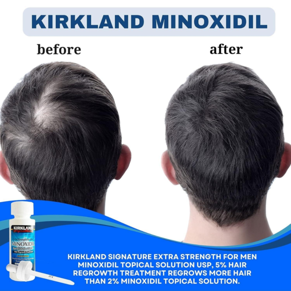 Kirkland 5% Minoxidil Extra Strength Hair Loss & Hair Regrowth Treatment for Men 60ml - Image 2